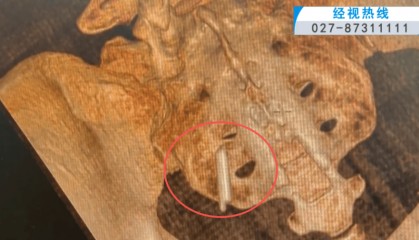 体温表在体内断裂,女子时隔22年彻底取出!医生:庆幸水银不在里面