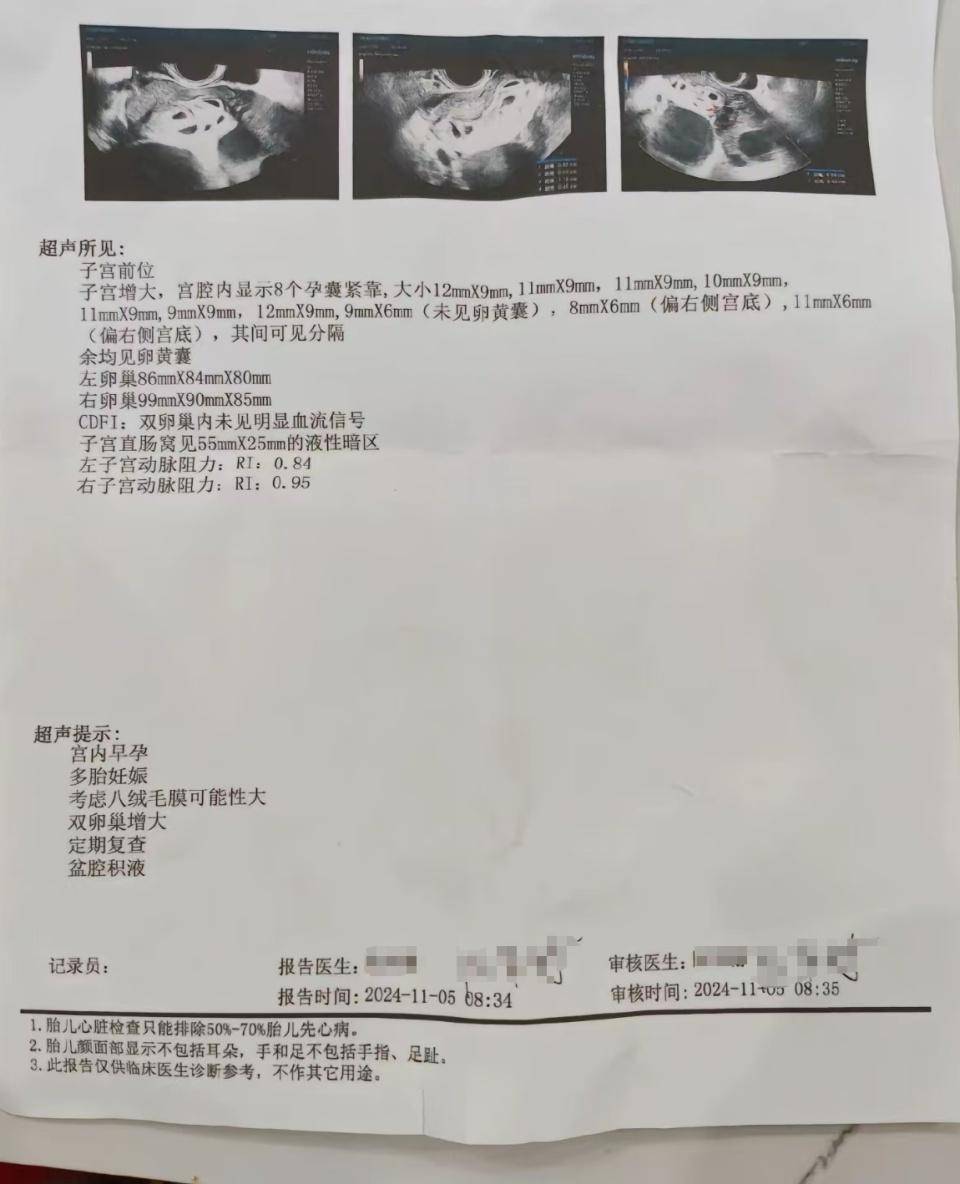 怀上9胞胎女子今日进行减胎手术：分两次进行<strong></p>
<p>新斯达克</strong>，第一次减去四个胚胎，第二次减去三个