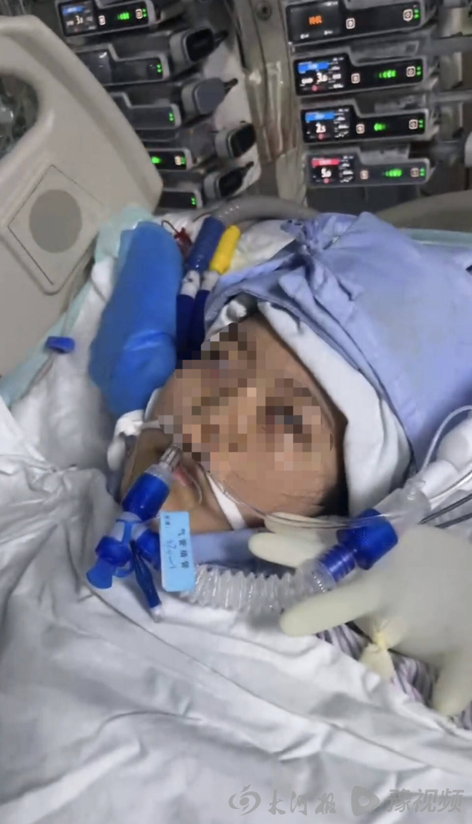 22岁美甲师手术成功却在复苏室脑死亡<strong></p>
<p>东南亚</strong>，家属称缺氧30分钟监护医生未察觉，医院回应